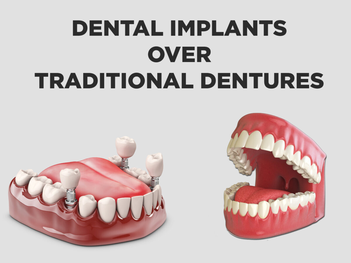 The Benefits of Dental Implants Over Traditional Dentures