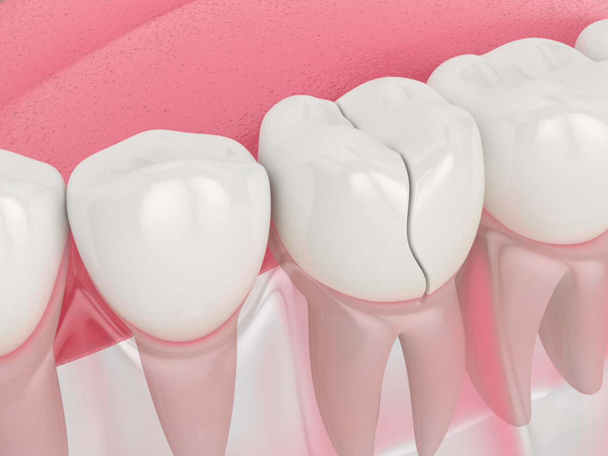 Cracked Tooth Syndrome: Symptoms, Treatments, And Prevention