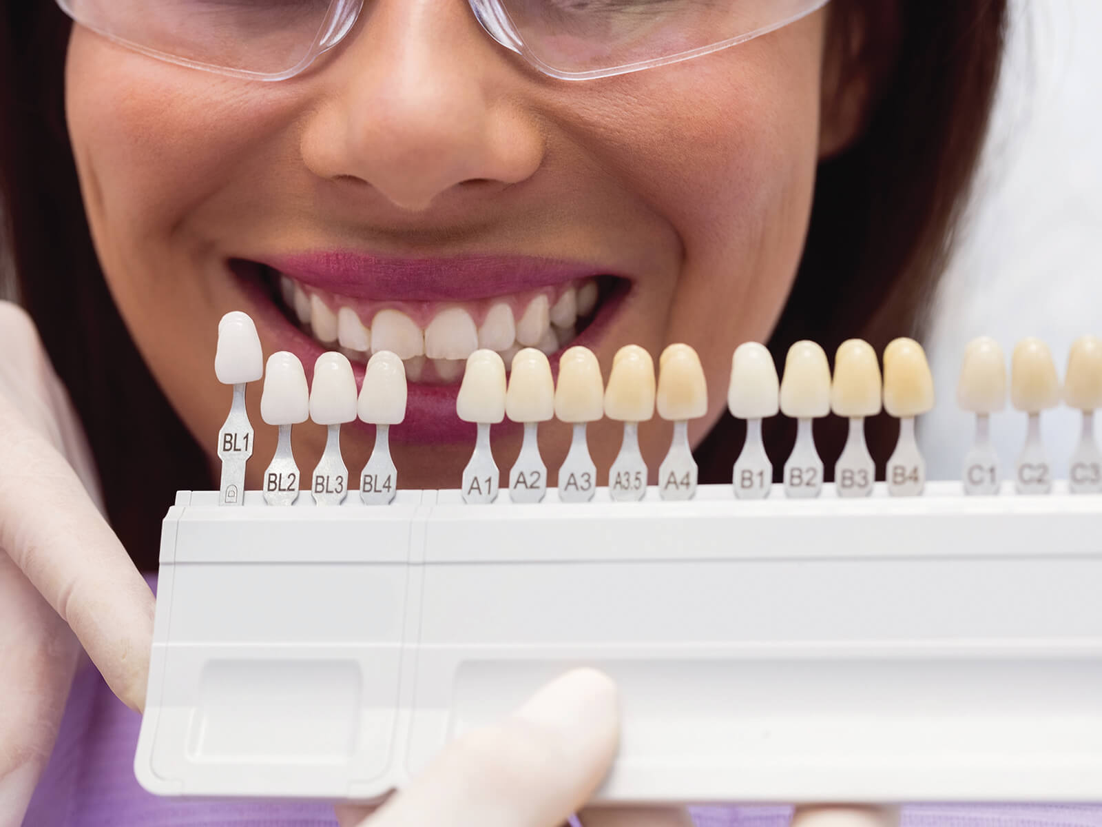 5 Benefits of Porcelain Veneers