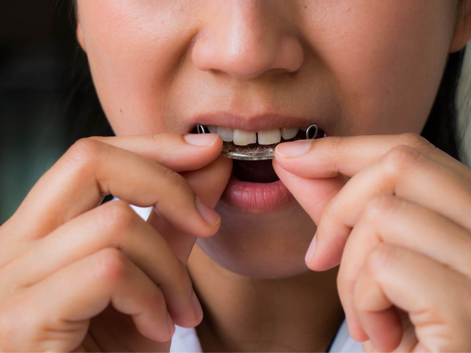 What You Need To Know About Gaps Between Teeth