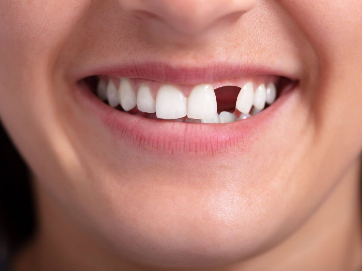 Understanding Tooth Loss And Its Impact On Oral Health