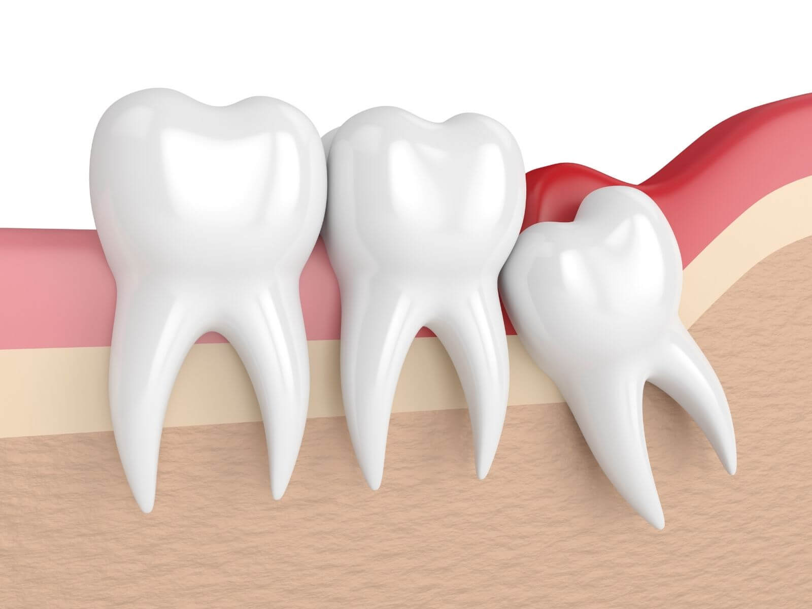 Why Impacted Wisdom Teeth May Require Extraction