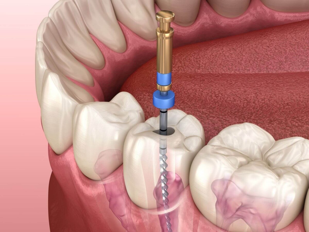 5 Common Reasons You May Need A Root Canal