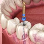 5 Common Reasons You May Need A Root Canal